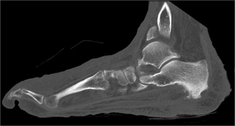 Foot and Ankle CT Scan - Advanced 3D Imaging